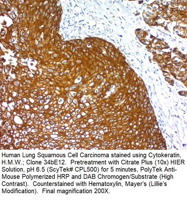 Cytokeratin, Basic (Type II or HMW) (Epithelial Marker); Clone 34BE12 (Concentrate)