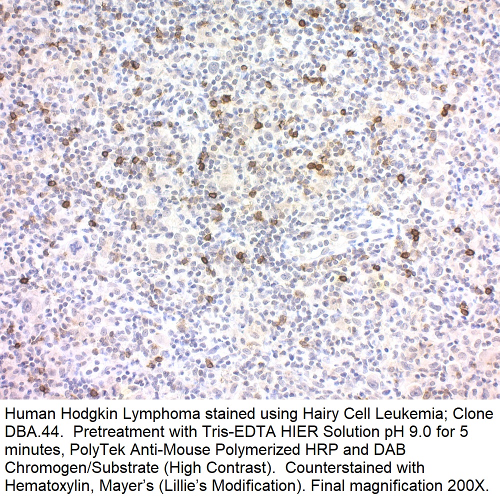 Hairy Cell Leukemia; Clone DBA.44 (Ready-To-Use)
