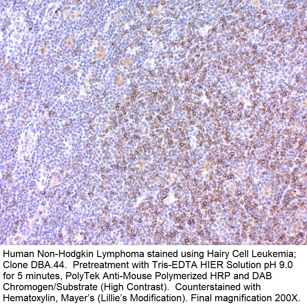 Hairy Cell Leukemia; Clone DBA.44 (Ready-To-Use)