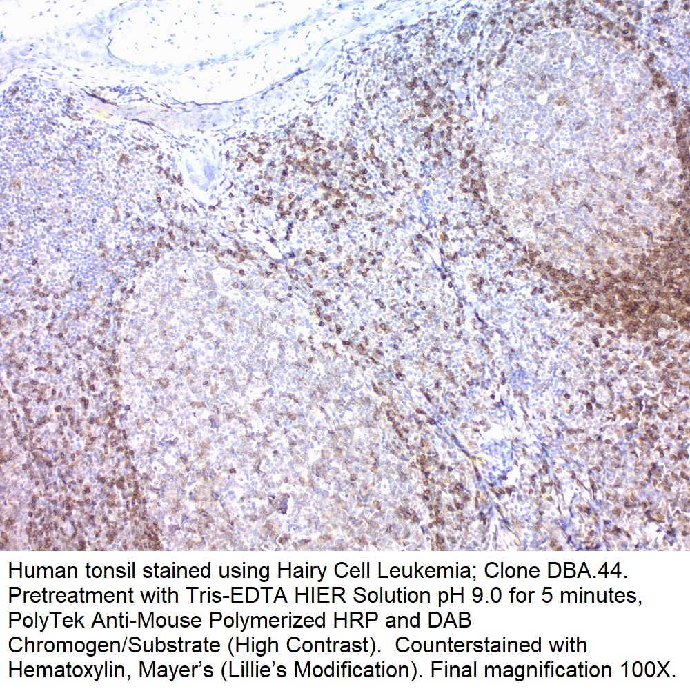 Hairy Cell Leukemia; Clone DBA.44 (Ready-To-Use)