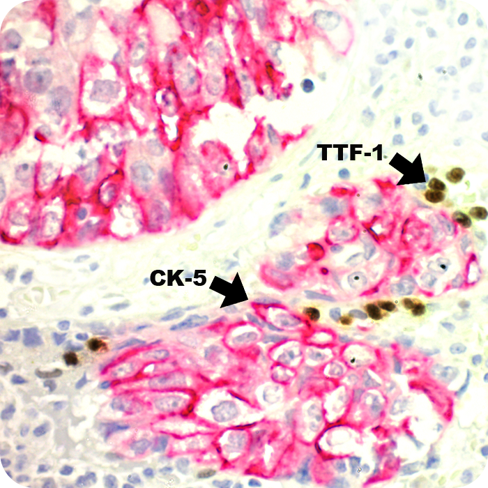 TTF-1 & Cytokeratin 5 Multiplex Cocktail; Clones 8G7G3/1 & EP42 (Ready-To-Use)