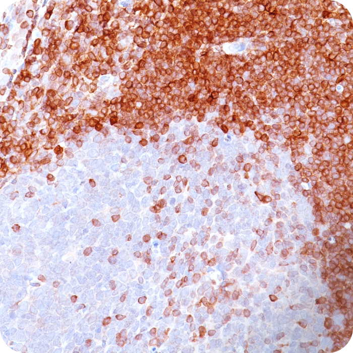 Bcl-2 (Apoptosis and Follicular Lymphoma Marker); Clone 100/D5 (Concentrate)