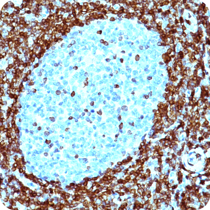 Bcl-2 (Apoptosis and Follicular Lymphoma Marker); Clone 124 (Concentrate)