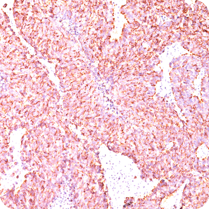 Chromogranin A / CHGA (Neuroendocrine Marker); Clone PHE5 (Concentrate)