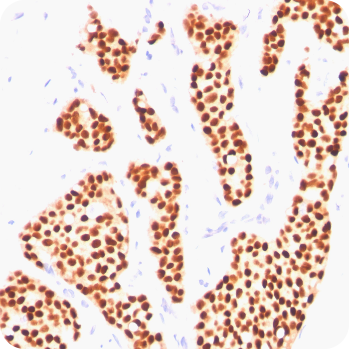 Estrogen Receptor (Marker of Estrogen Dependence); Clone ER505 (Concentrate)