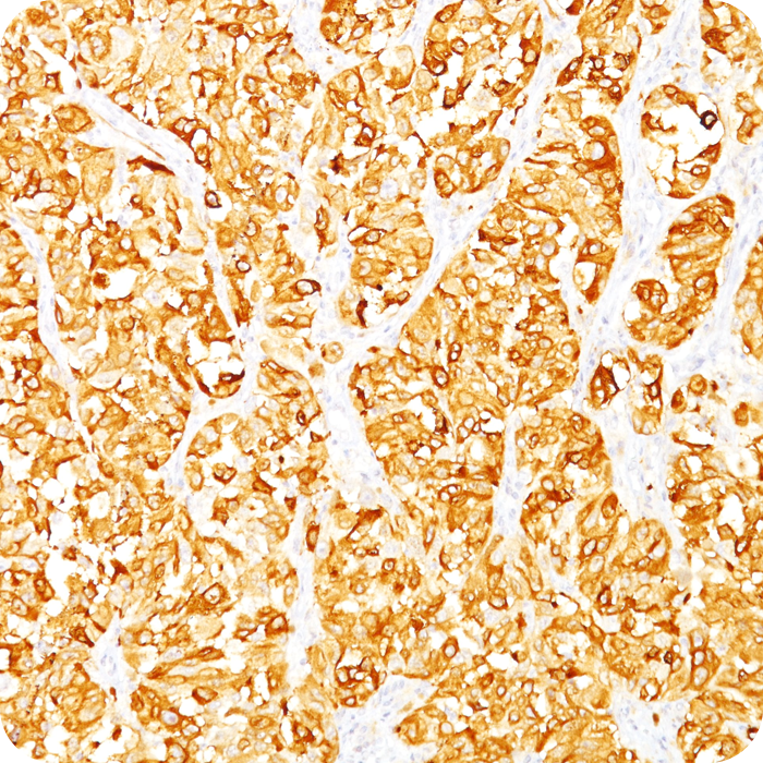 MART-1 / Melan-A / MLANA (Melanoma Marker); Clone DT101 & BC199 (Concentrate)