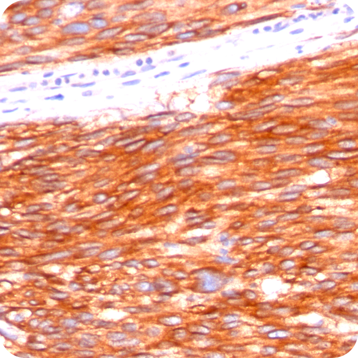 CD117/c-Kit (Marker for Gastrointestinal Stromal Tumors); Clone C117/370 (Concentrate)