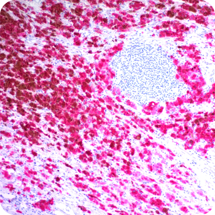 Microphthalmia Transcription Factor (MITF); Clone C5/D5 (Concentrate)