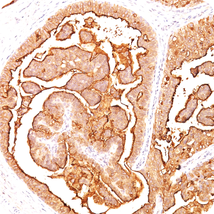 MUC1 / EMA / CD227 (Epithelial Marker); Clone E29 (Concentrate)