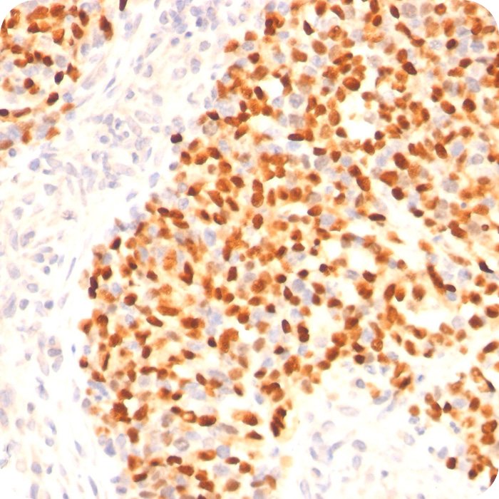 MyoD1 (Rhabdomyosarcoma Marker); Clone 5.8A (Concentrate)
