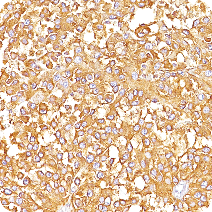 gp100 / Melanosome / PMEL17 / SILV (Melanoma Marker); Clone HMB45 (Concentrate)