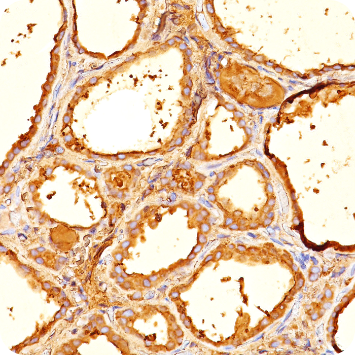 Thyroglobulin (Thyroidal Cell Marker); Clone 6E1 (Concentrate)