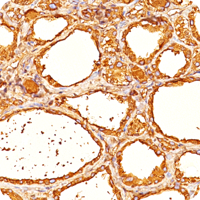Thyroglobulin (Thyroidal Cell Marker); Clone 2H11 & 6E1 (Concentrate)