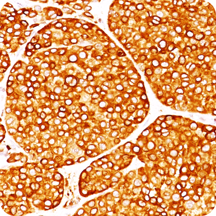Tyrosinase (Melanoma Marker); Clone T311 (Concentrate)