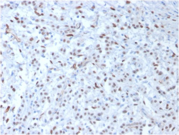 Wilm's Tumor 1 (WT1) (Wilm's Tumor & Mesothelial Marker); Clone WT1/857 (Concentrate)