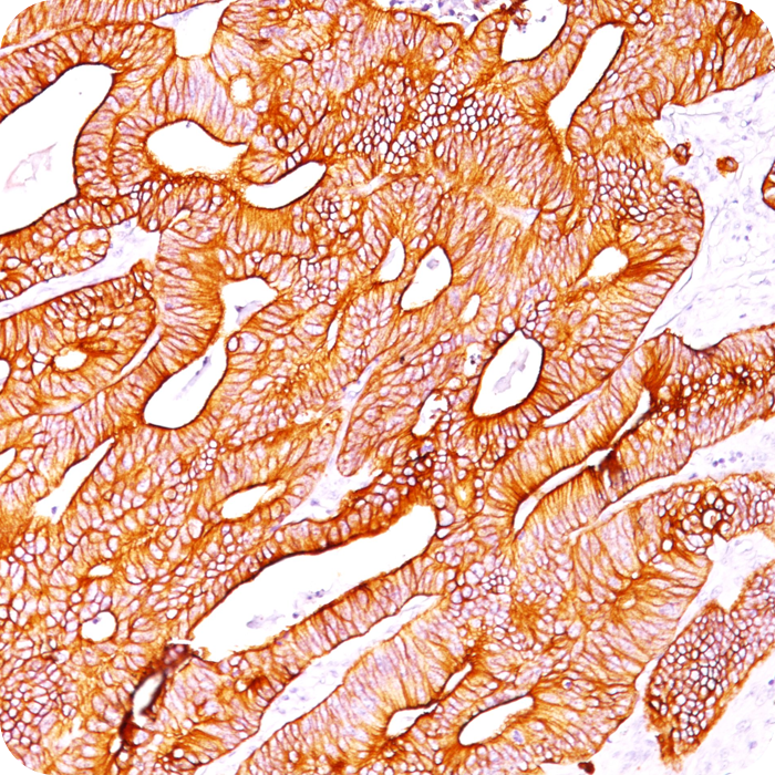 Cytokeratin, Pan (Epithelial Marker); Clone AE-1 & AE-3 (Concentrate)