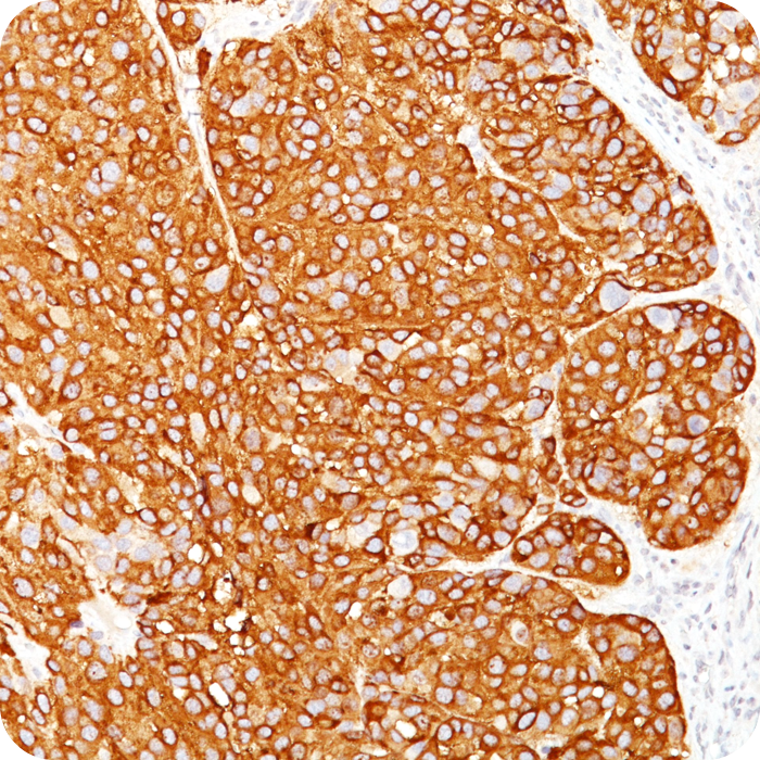 Melanoma Marker (MART-1, Tyrosinase, & gp100); Clone M2-7C10, M2-9E3, T311, & HMB45 (Concentrate)