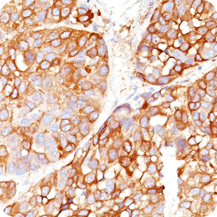 Melanoma Marker (MART-1, Tyrosinase, & gp100); Clone DT101, BC199, T311, & HMB45 (Concentrate)