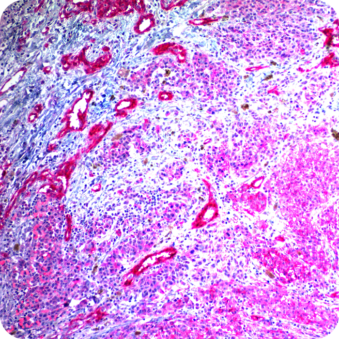 KBA.62 (Melanoma Associated Antigen); Clone KBA.62 (Concentrate)