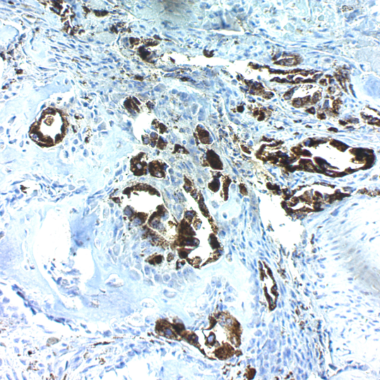 Napsin A (Lung Adenocarcinoma Marker); Clones NAPSA/1238 & NAPSA/1239 (Concentrate)