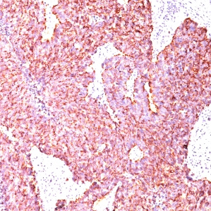 Chromogranin A / CHGA (Neuroendocrine Marker); Clone SPM585 (Concentrate)