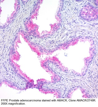 AMACR / p504S (Prostate Cancer Marker); Clone AMACR/2748R (Concentrate)