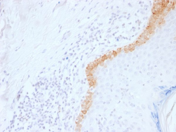 Cytokeratin 15 (Esophageal Squamous Cell Carcinoma Marker); Clone LHK15