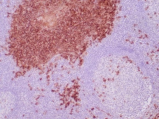 CD138 / Syndecan-1 (SDC1) (Plasma Cell Marker); Clone SDC1/7177
