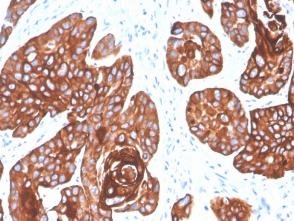 Cytokeratin 5/6 (Basal, Myoepithelial & Mesothelial Cell Marker); Clone KRT5.6/4866