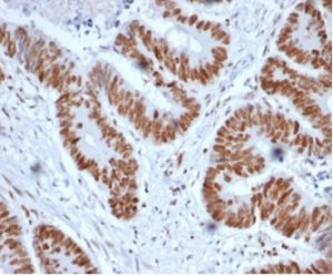 MSH2 (DNA Mismatch Repair Marker); Clone MSH2/6852